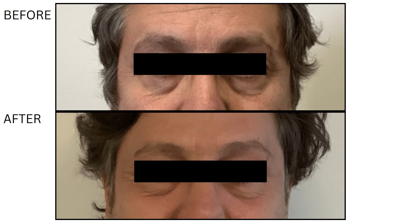 Fraxel (Lasers), before and after photograph 5