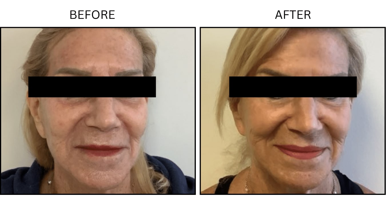 Fraxel (Lasers), before and after photograph 6