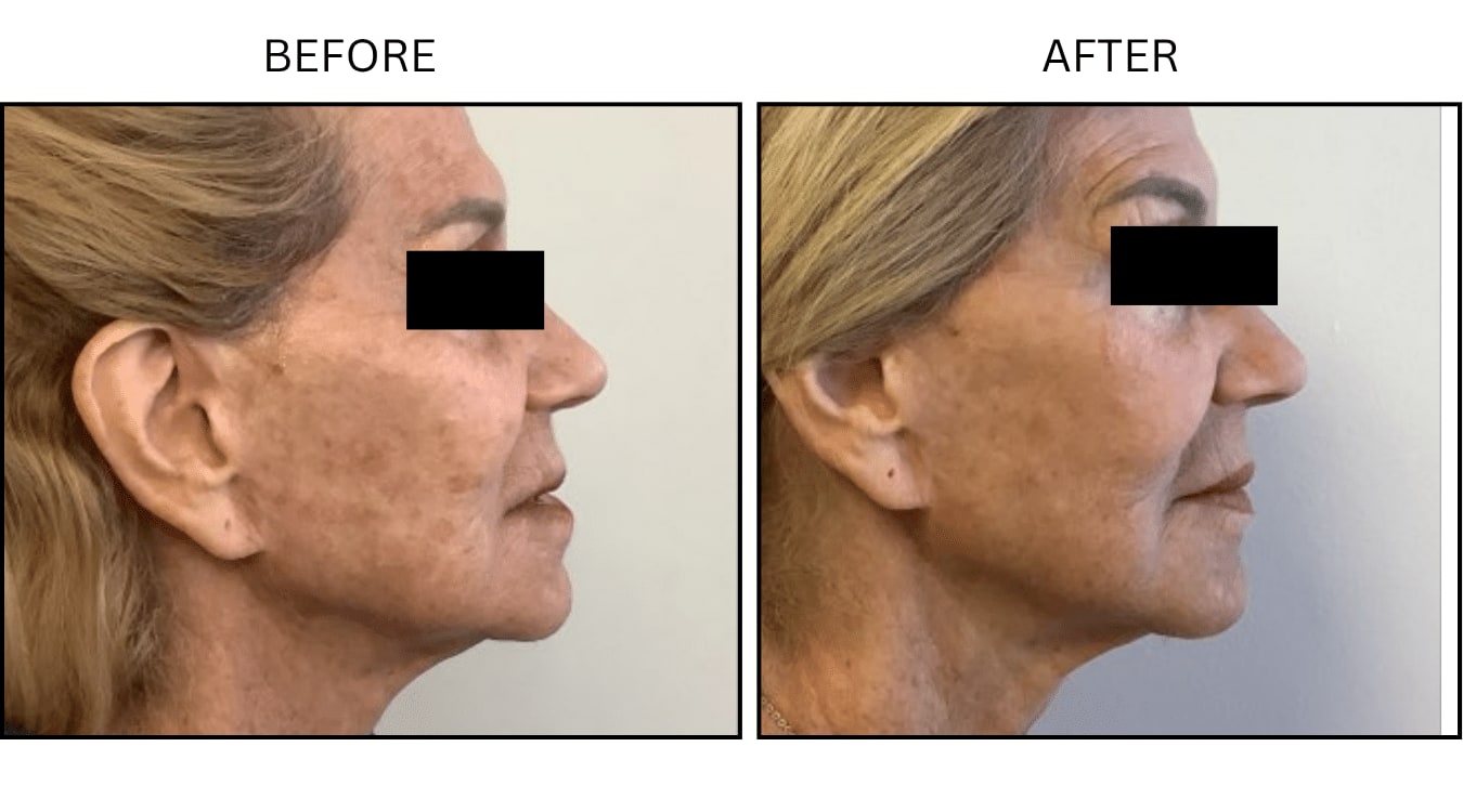 Fraxel (Lasers), before and after photograph 7
