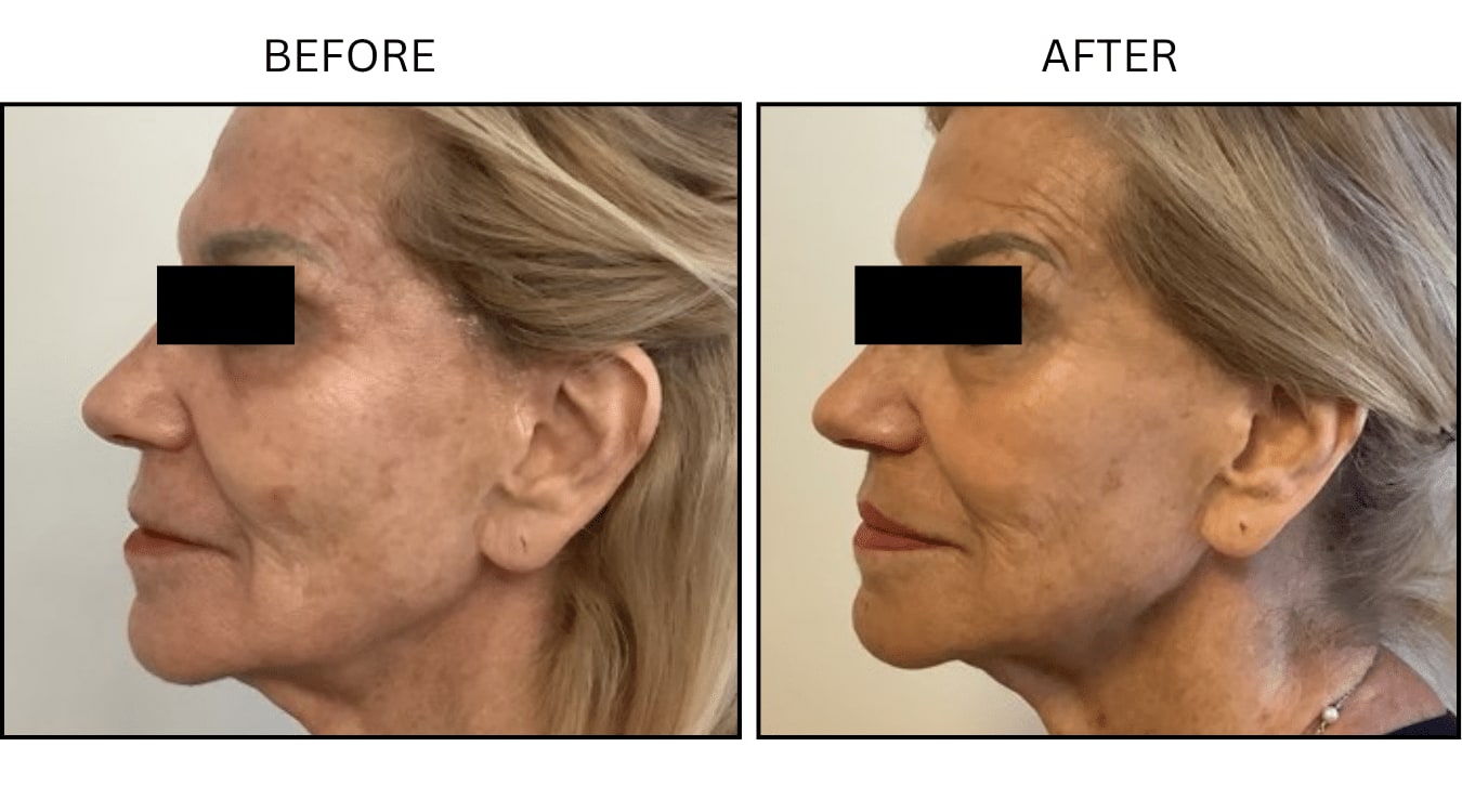 Fraxel (Lasers), before and after photograph 8