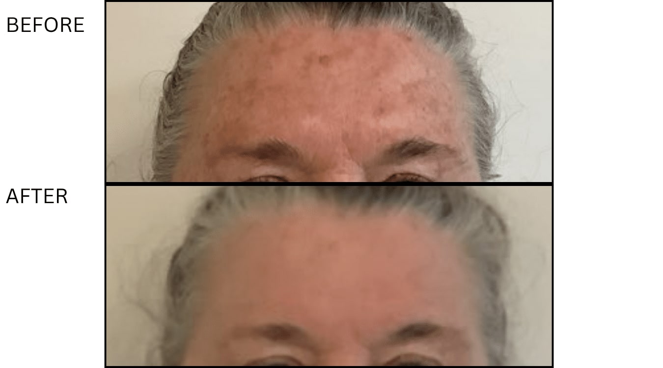 Fraxel (Lasers), before and after photograph 9