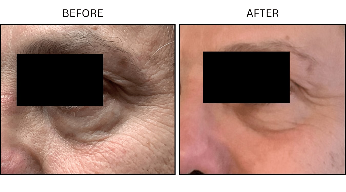 Fraxel (Lasers), before and after photograph 11