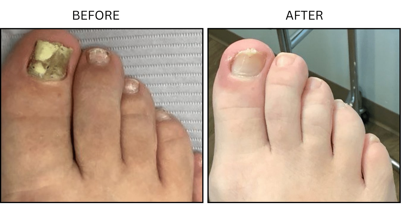 Fungus (Medical), before and after photograph 2