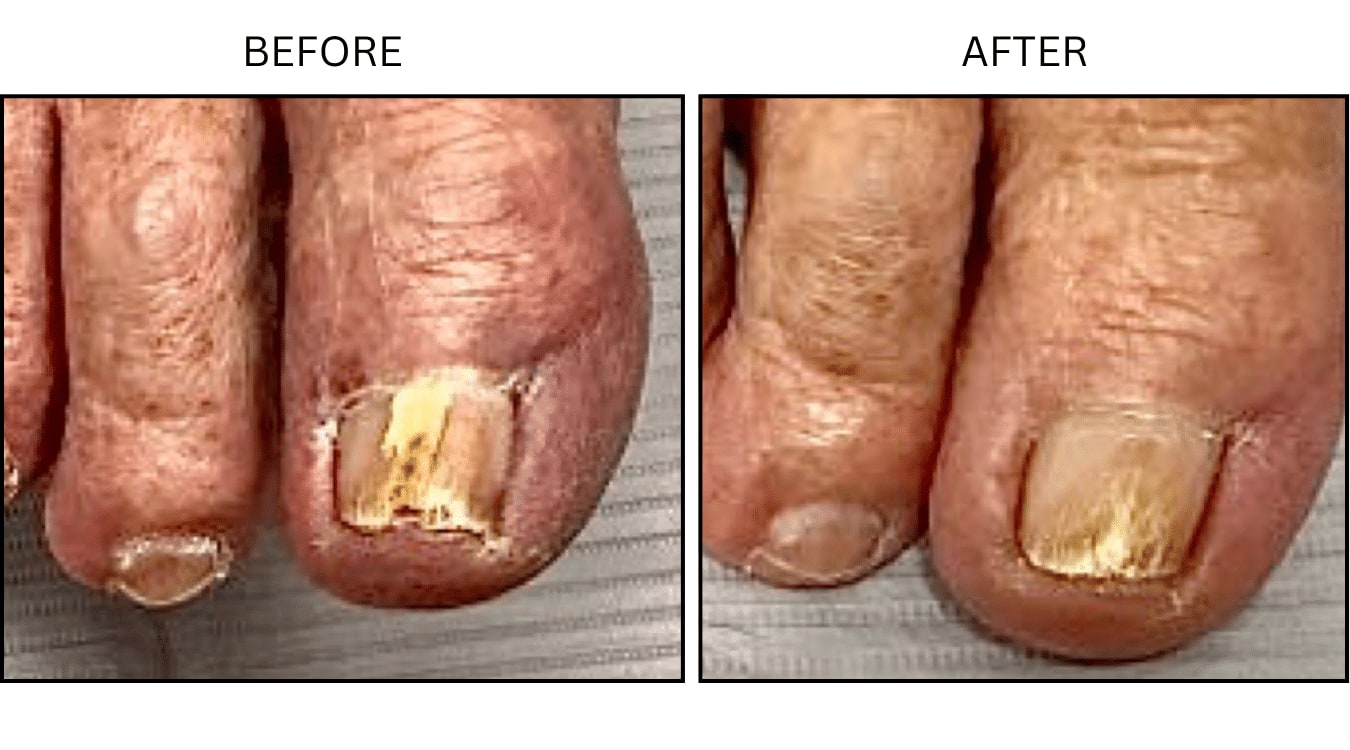 Fungus (Medical), before and after photograph 4