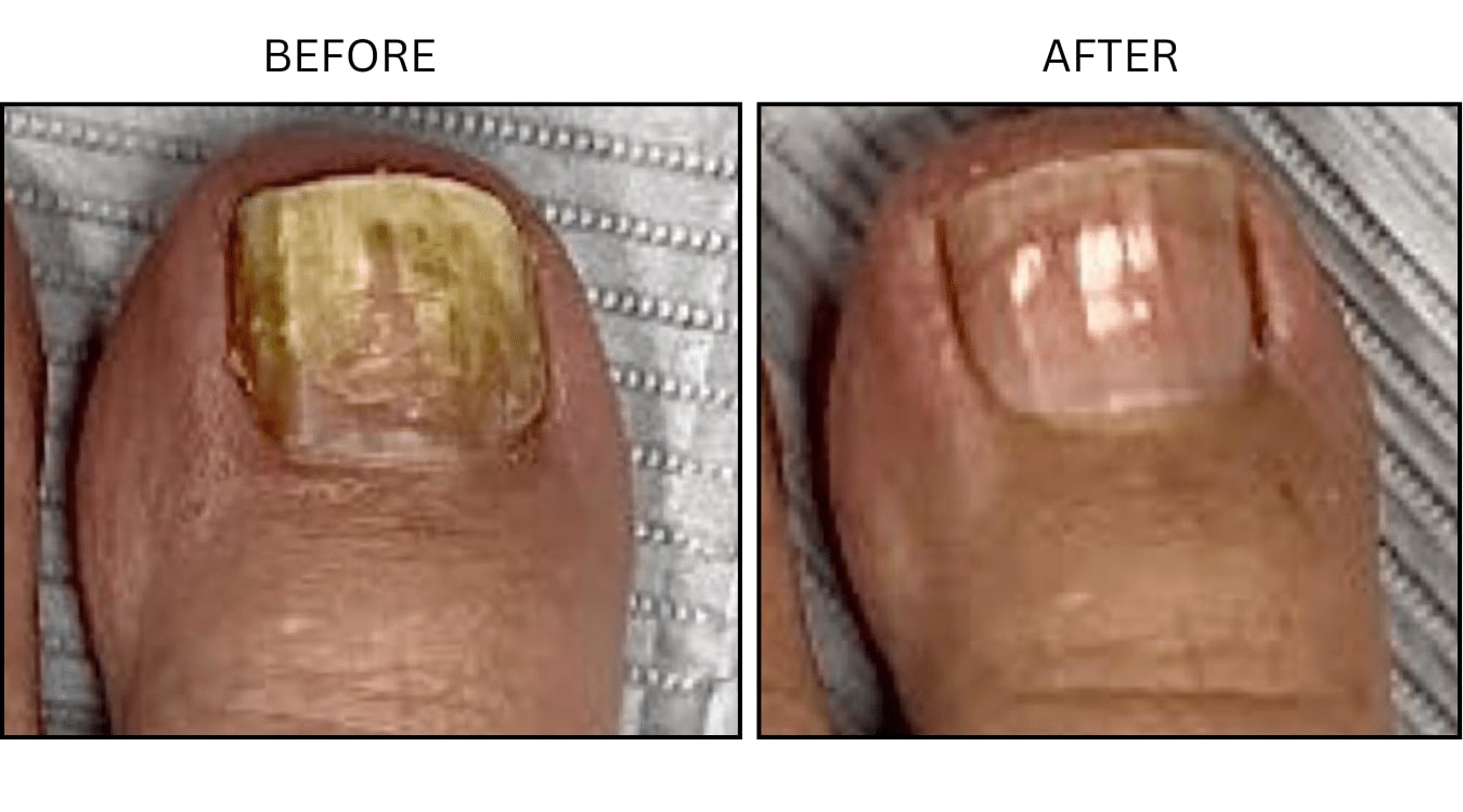 Fungus (Medical), before and after photograph 3