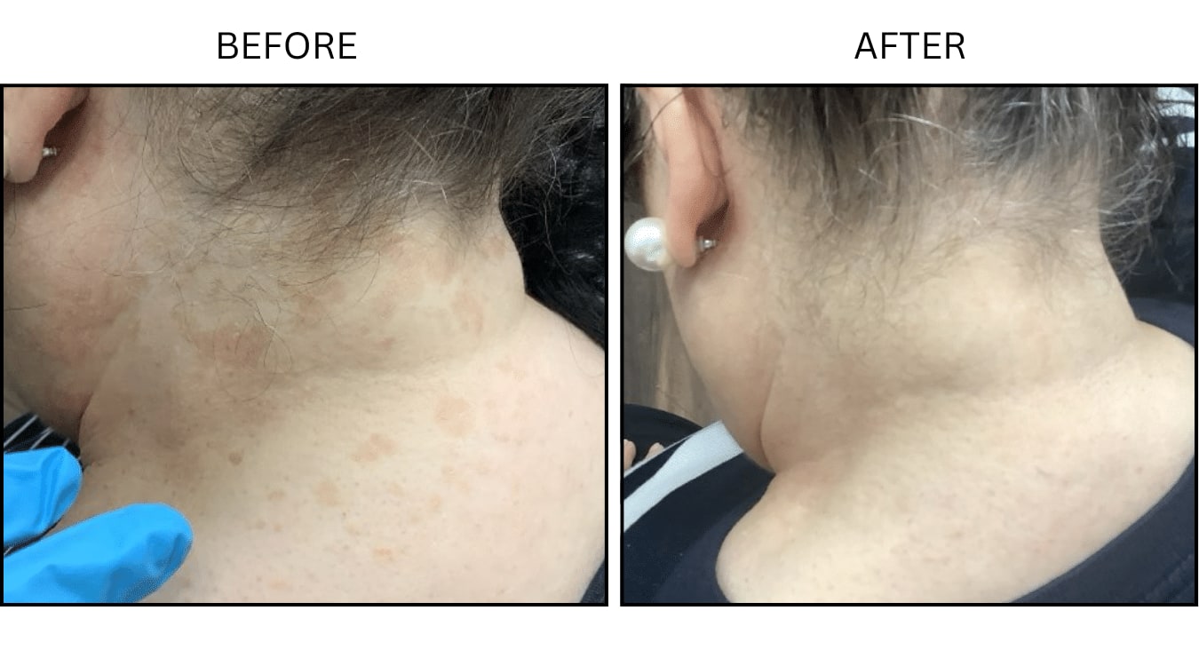 Fungus (Medical), before and after photograph 1