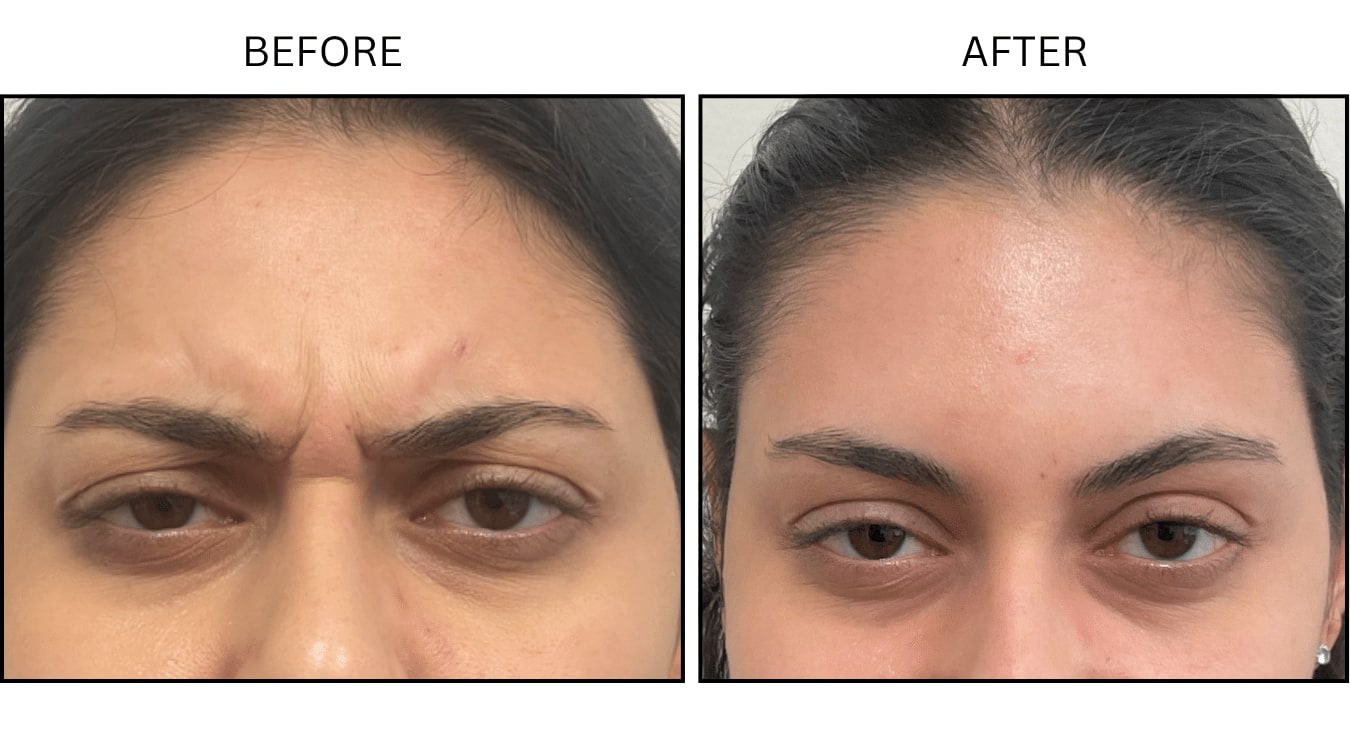 Glabellar (frown Lines) (Neurotoxin Relaxers), before and after photograph 1