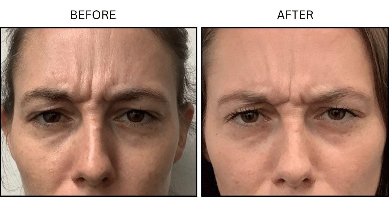 Glabellar (frown Lines) (Neurotoxin Relaxers), before and after photograph 2