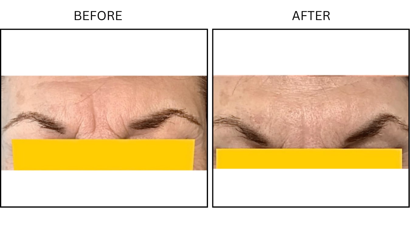 Glabellar (frown Lines) (Neurotoxin Relaxers), before and after photograph 3