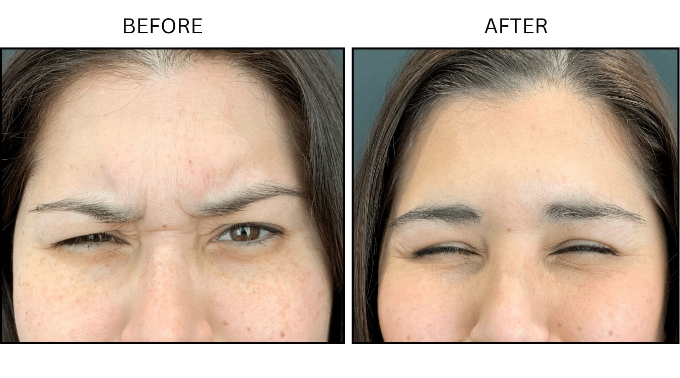 Glabellar (frown Lines) (Neurotoxin Relaxers), before and after photograph 4