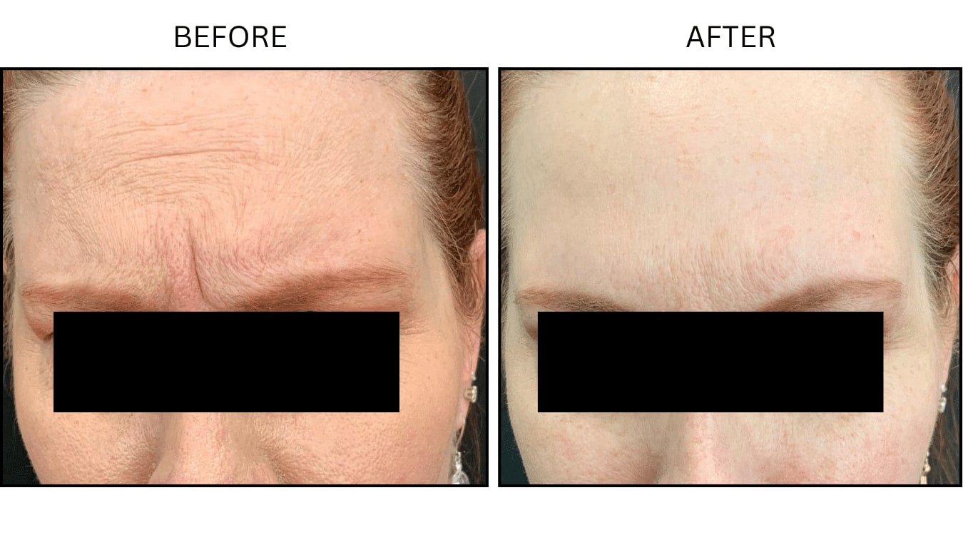 Glabellar (frown Lines) (Neurotoxin Relaxers), before and after photograph 5