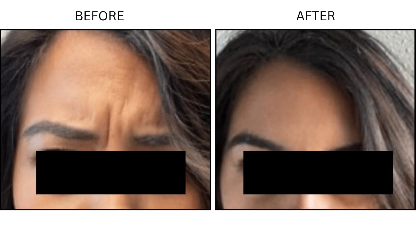 Glabellar (frown Lines) (Neurotoxin Relaxers), before and after photograph 6