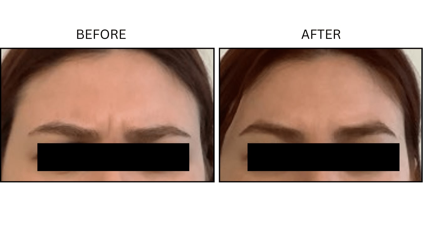 Glabellar (frown Lines) (Neurotoxin Relaxers), before and after photograph 15