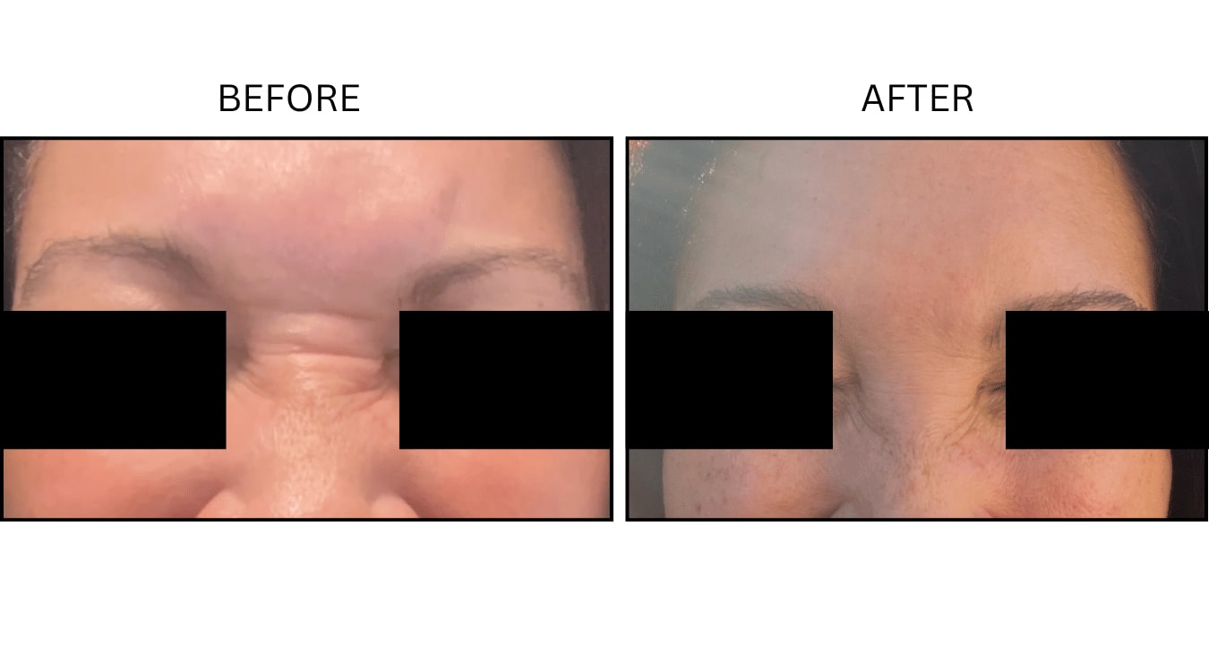 Glabellar (frown Lines) (Neurotoxin Relaxers), before and after photograph 16