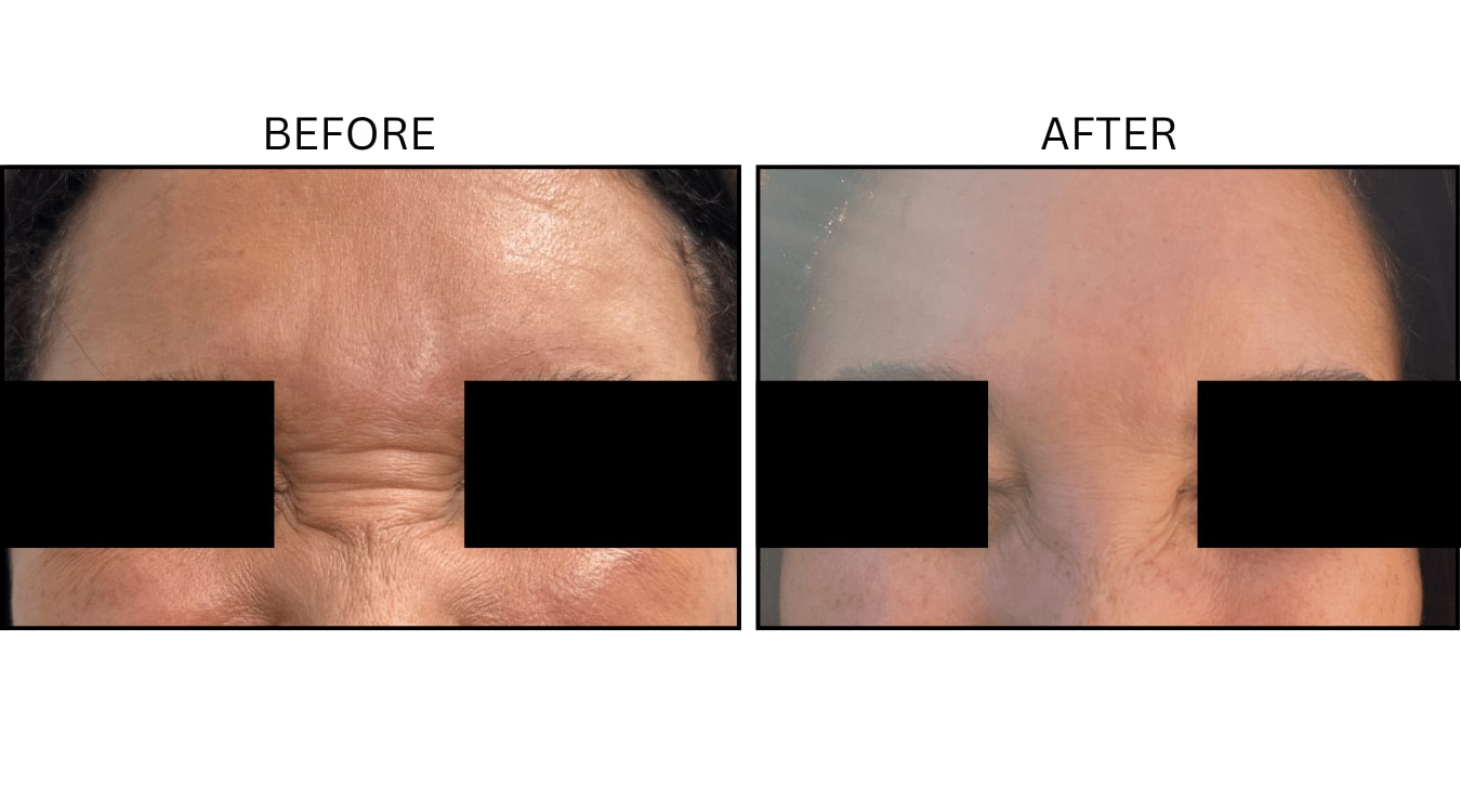 Glabellar (frown Lines) (Neurotoxin Relaxers), before and after photograph 17