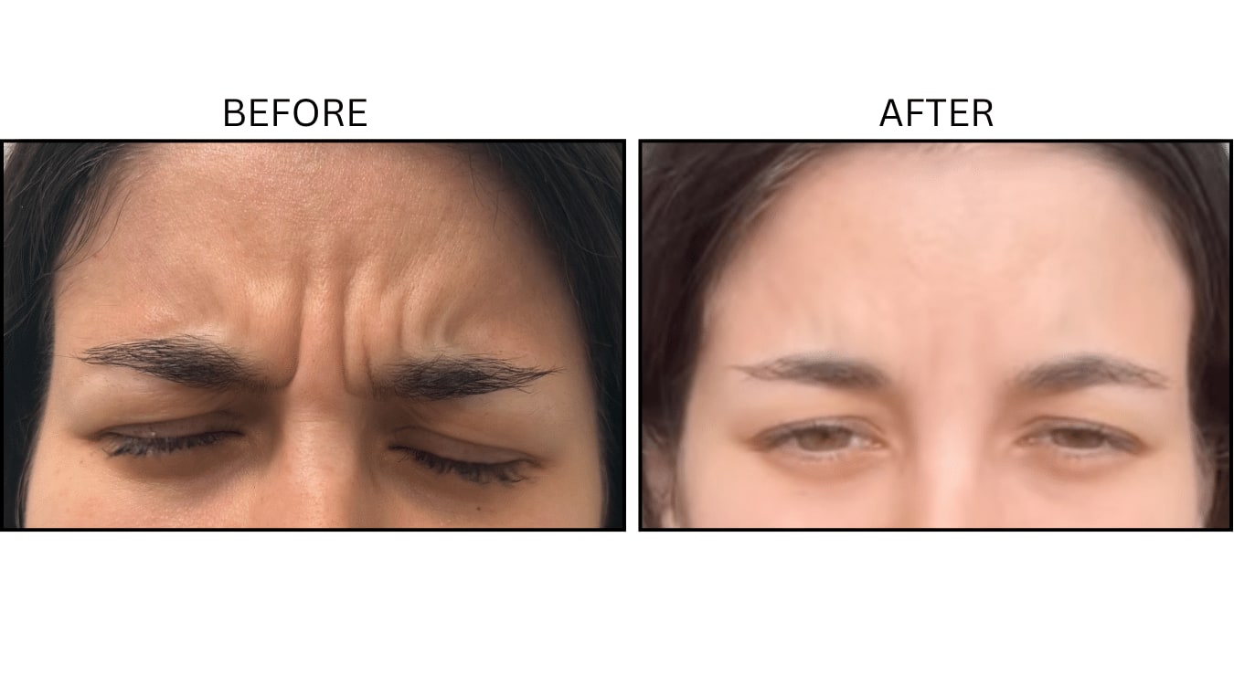 Glabellar (frown Lines) (Neurotoxin Relaxers), before and after photograph 18