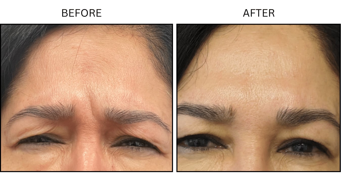 Glabellar (frown Lines) (Neurotoxin Relaxers), before and after photograph 7