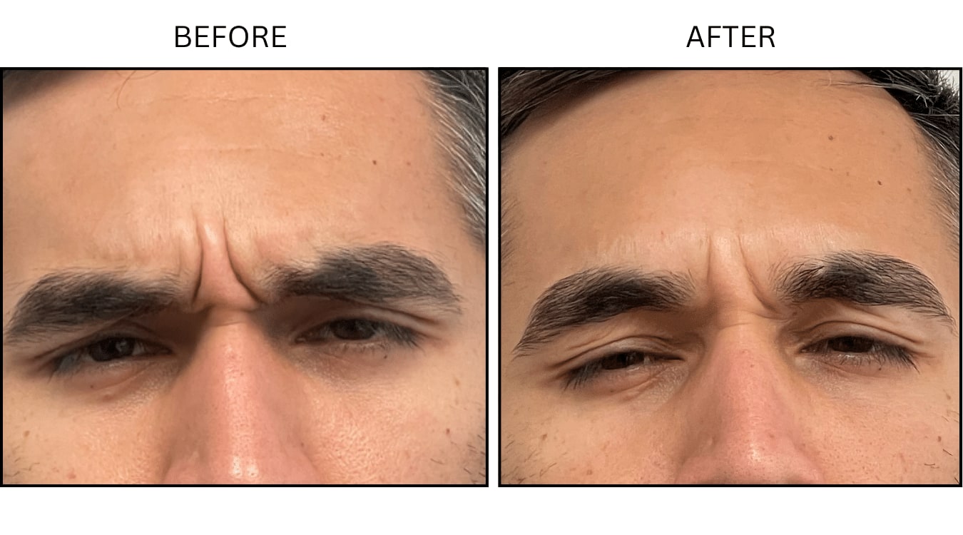 Glabellar (frown Lines) (Neurotoxin Relaxers), before and after photograph 8