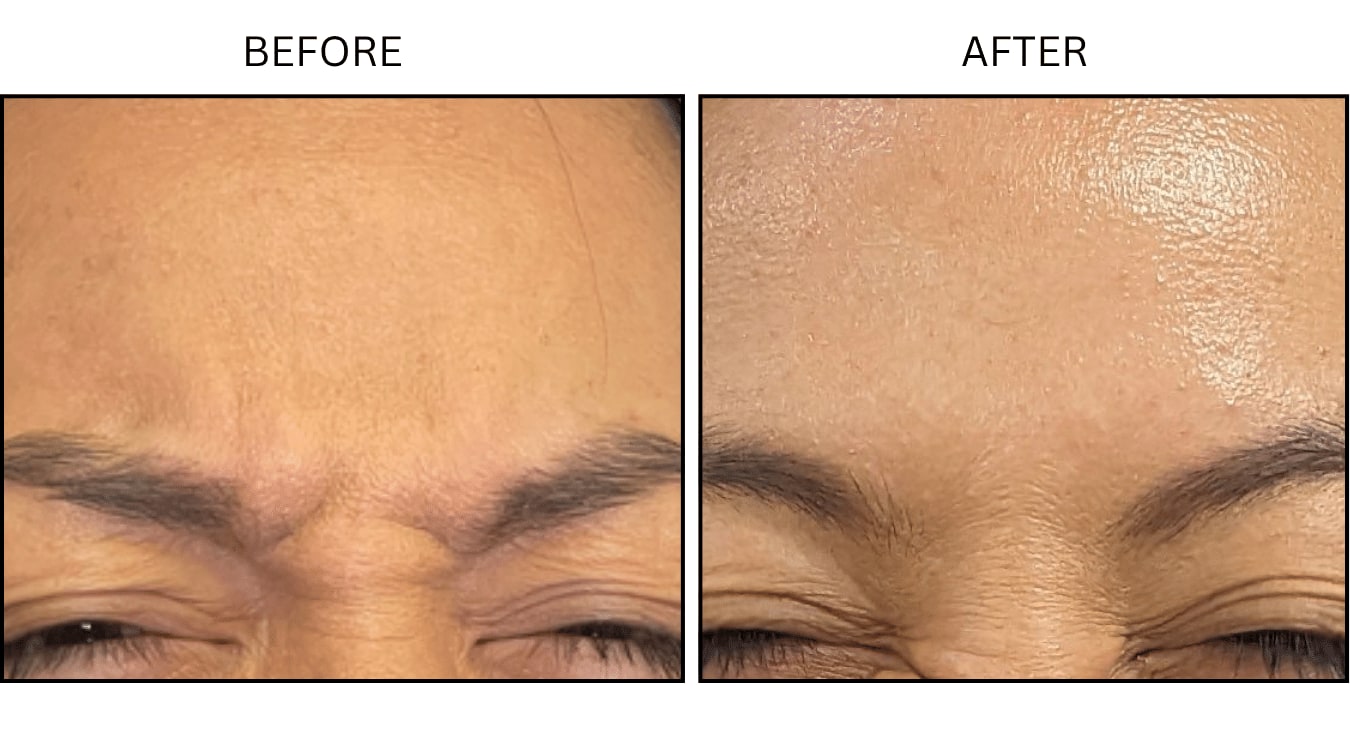 Glabellar (frown Lines) (Neurotoxin Relaxers), before and after photograph 9