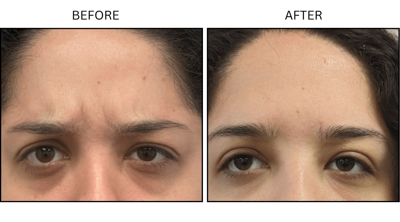 Glabellar (frown Lines) (Neurotoxin Relaxers), before and after photograph 10