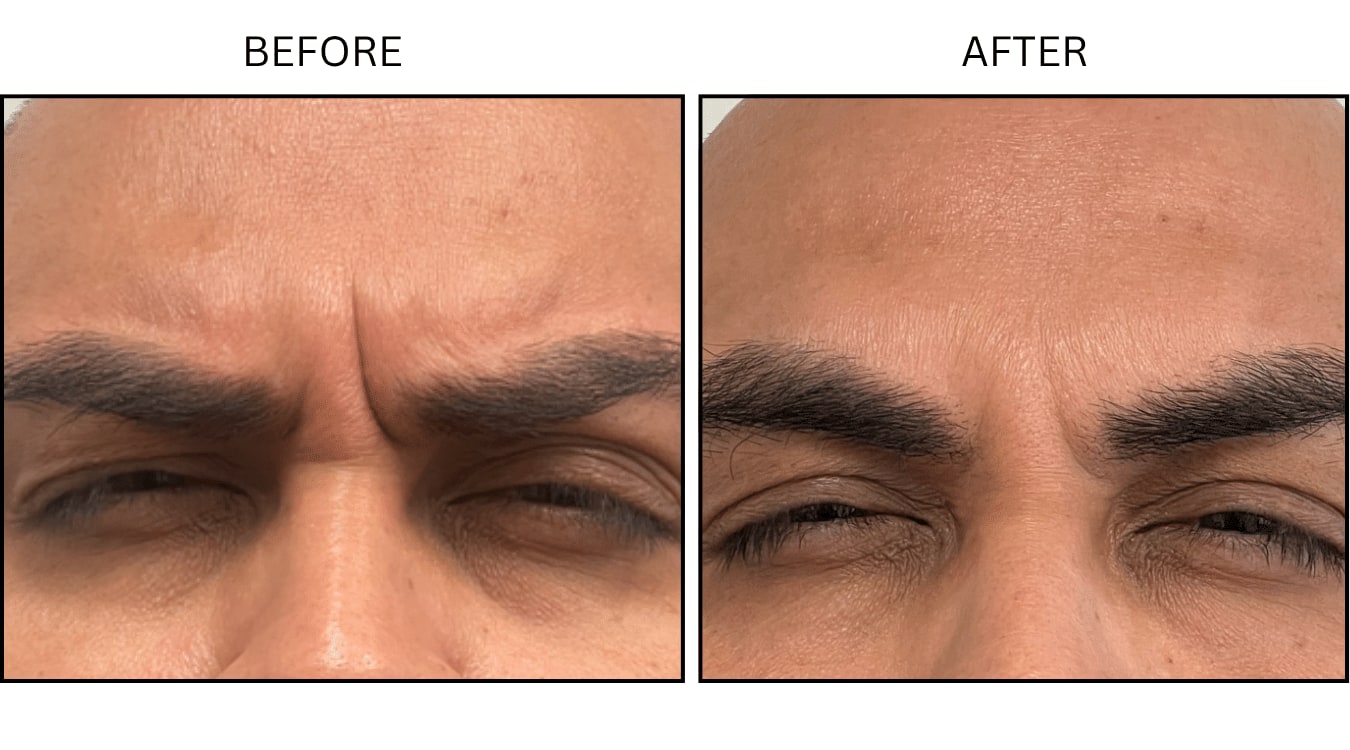 Glabellar (frown Lines) (Neurotoxin Relaxers), before and after photograph 11