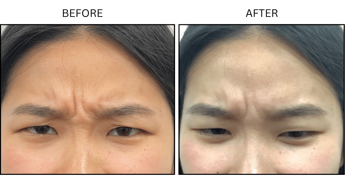 Glabellar (frown Lines) (Neurotoxin Relaxers), before and after photograph 12