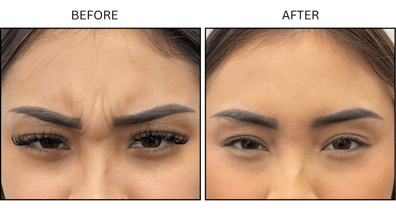 Glabellar (frown Lines) (Neurotoxin Relaxers), before and after photograph 13