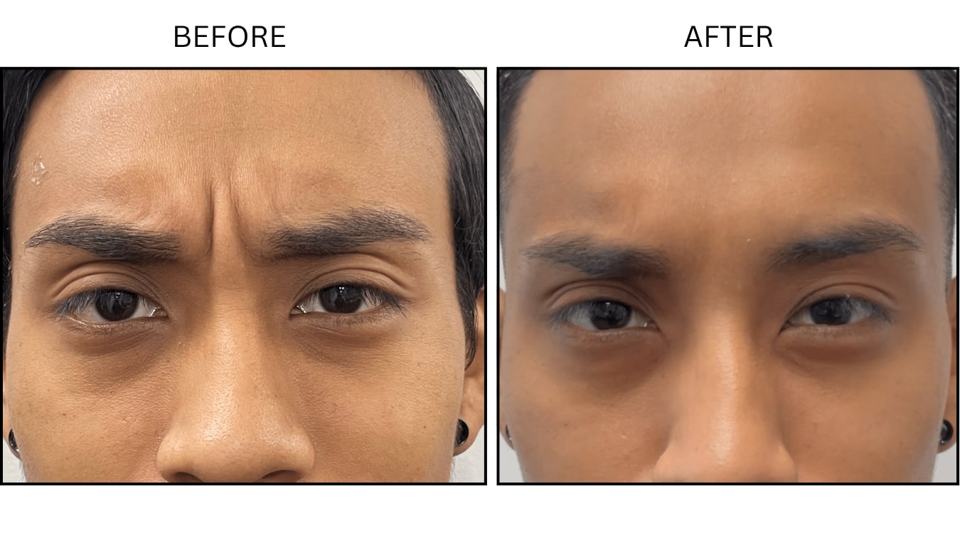 Glabellar (frown Lines) (Neurotoxin Relaxers), before and after photograph 14