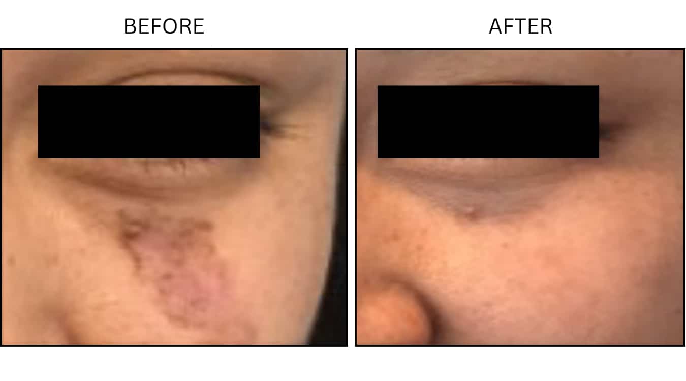 Growths (Lasers), before and after photograph 1