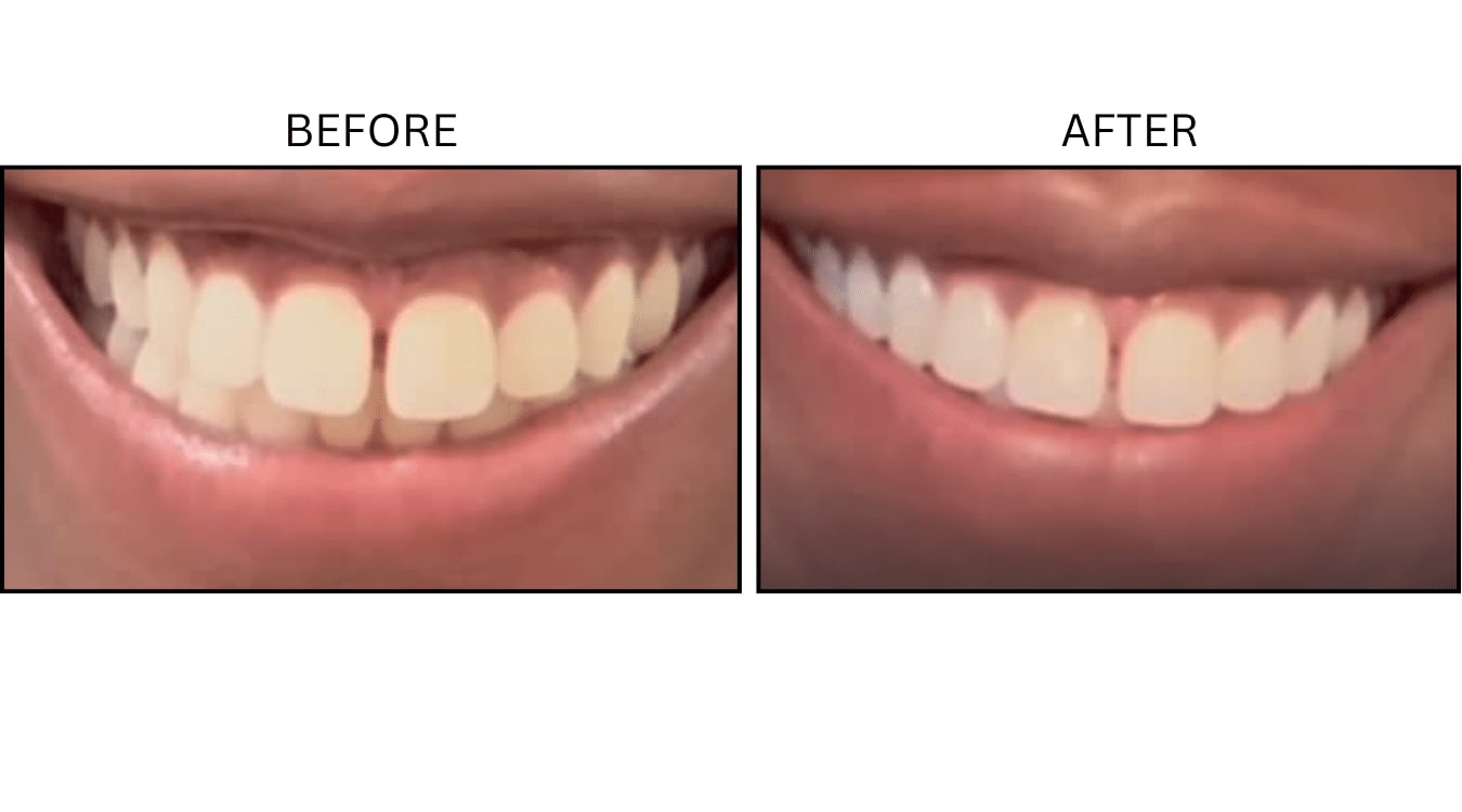 Gummy Smile (Neurotoxin Relaxers), before and after photograph 1