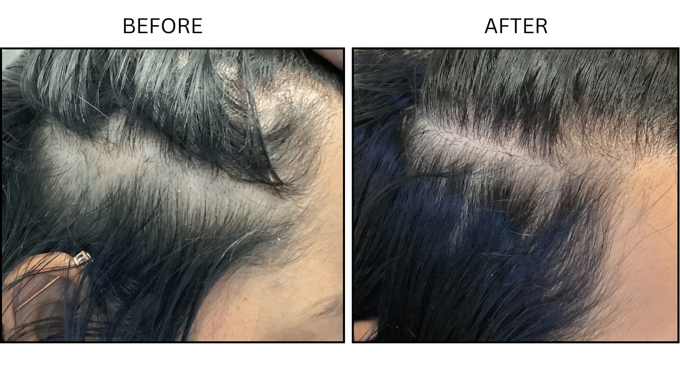 Hair (female) (PRP), before and after photograph 1