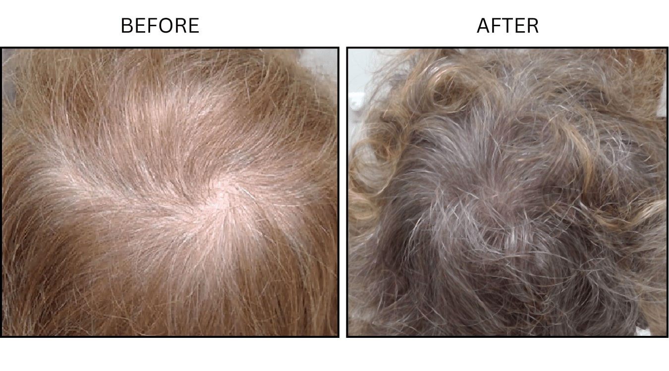 Hair (female) (PRP), before and after photograph 2