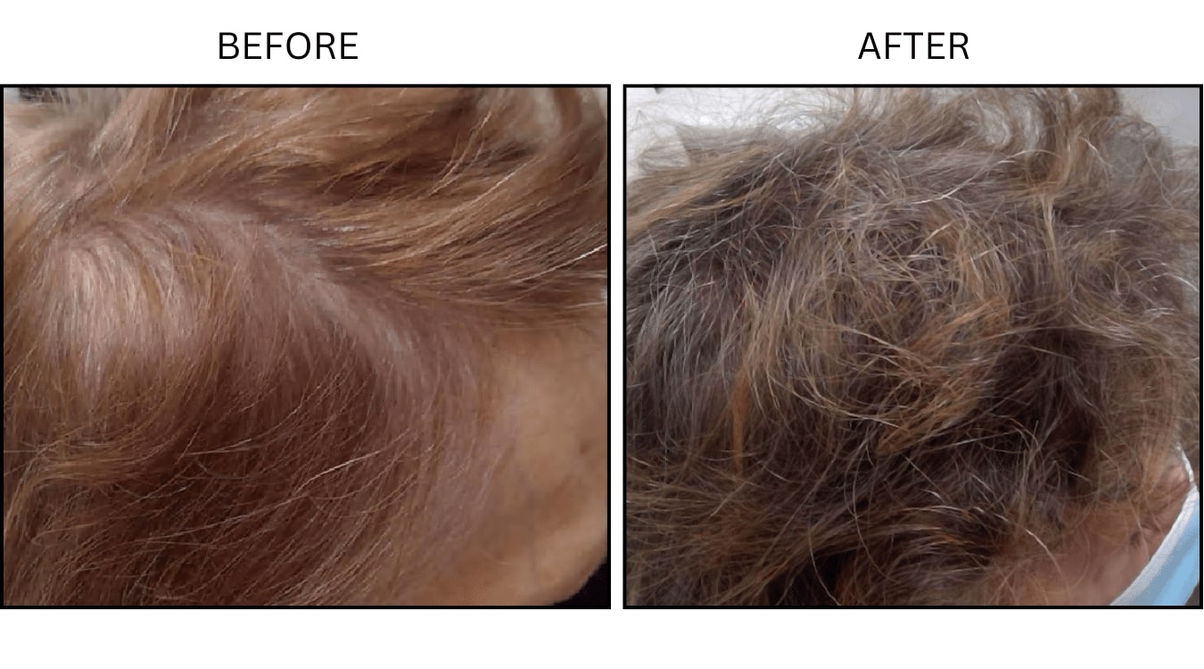 Hair (female) (PRP), before and after photograph 3