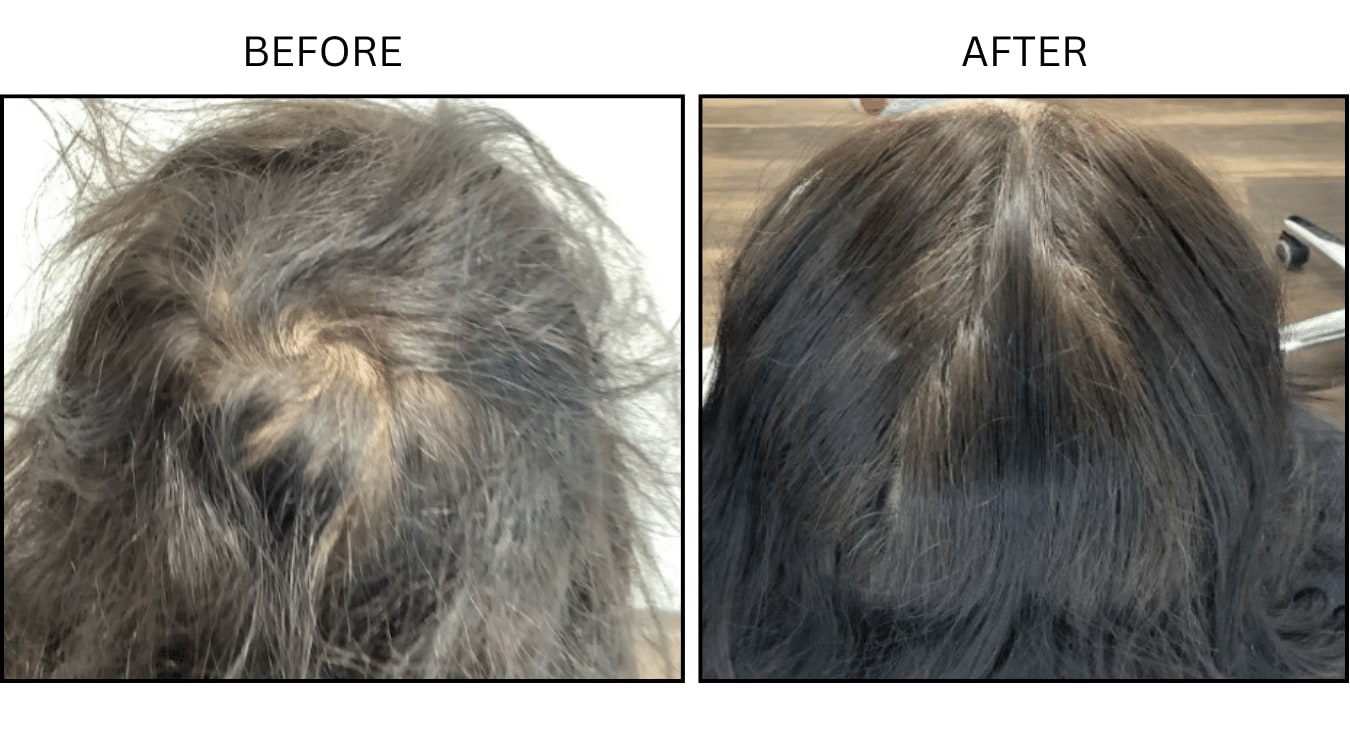 Hair (female) (PRP), before and after photograph 4