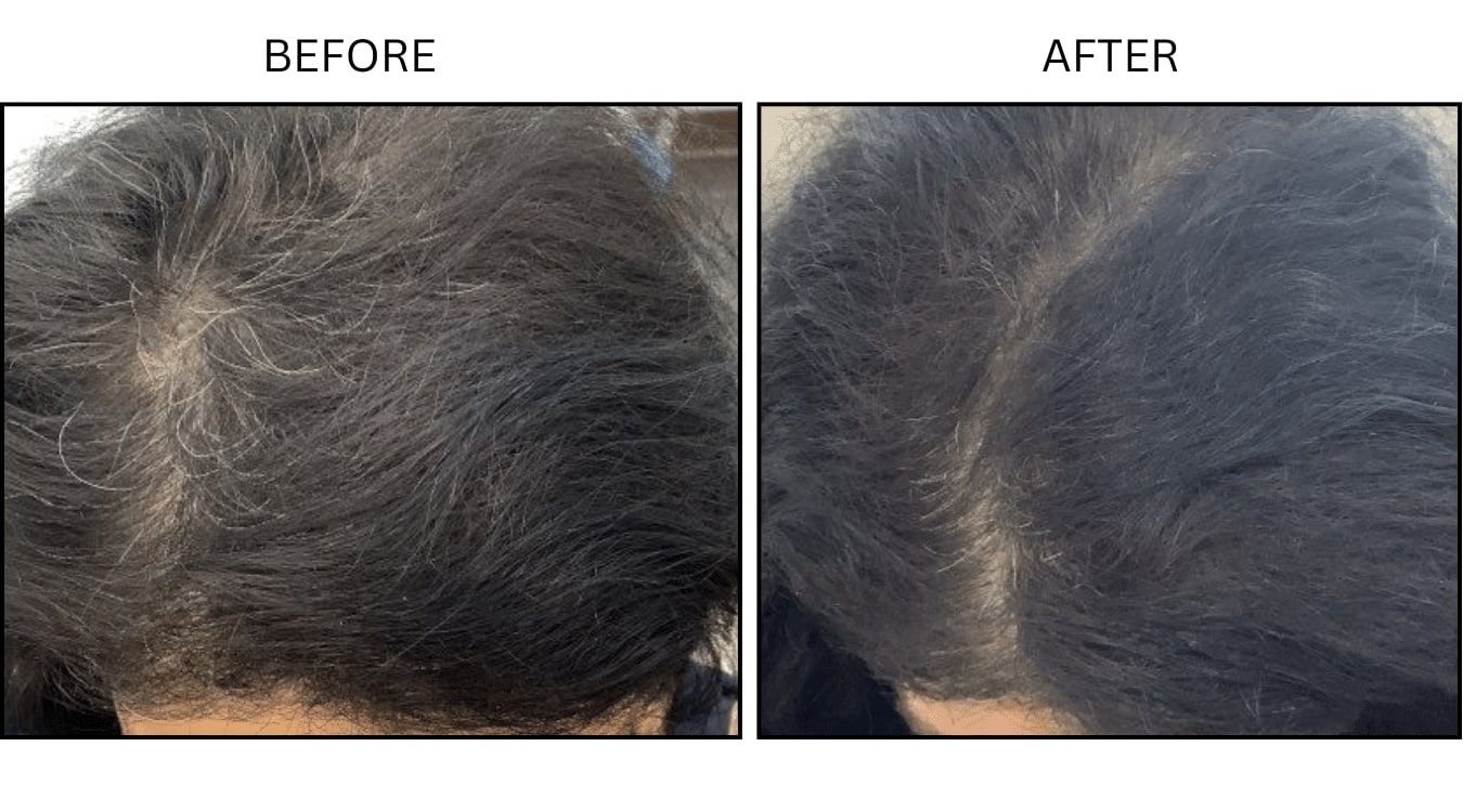 Hair (female) (PRP), before and after photograph 5