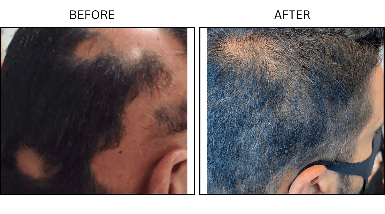 Hair Loss (Medical), before and after photograph 12