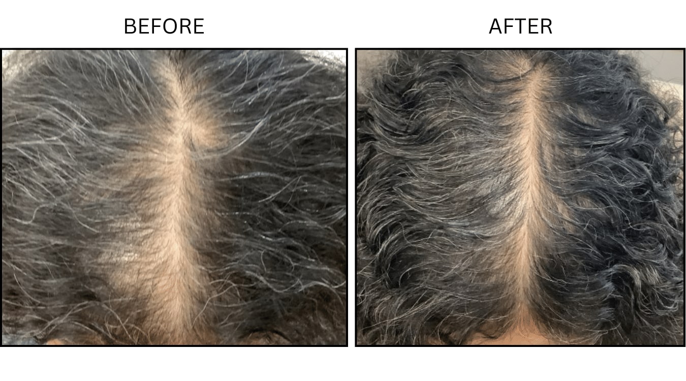 Hair Loss (Medical), before and after photograph 13