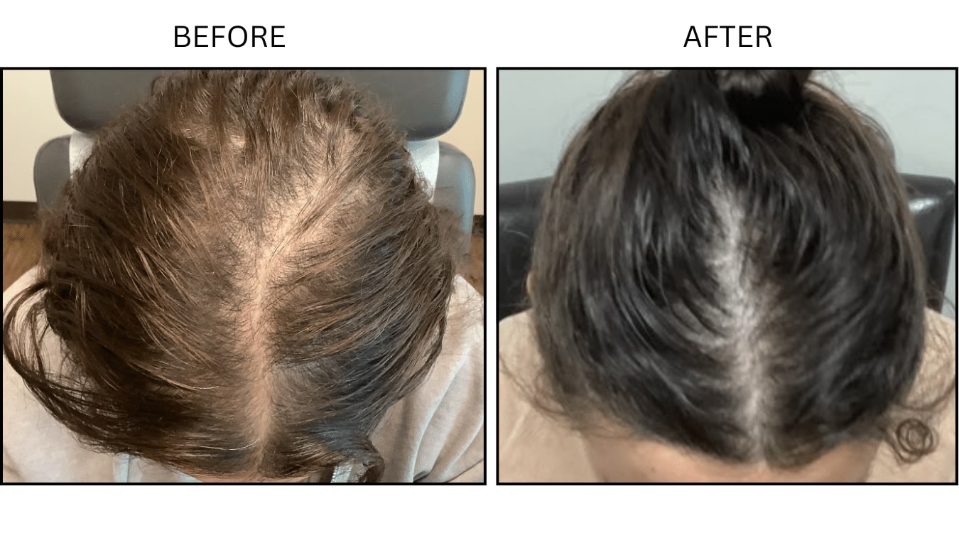 Hair Loss (Medical), before and after photograph 14