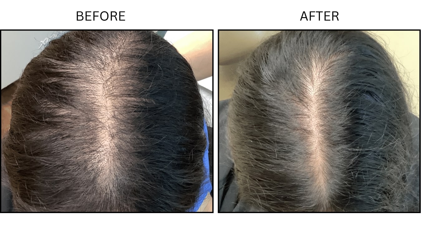 Hair Loss (Medical), before and after photograph 15