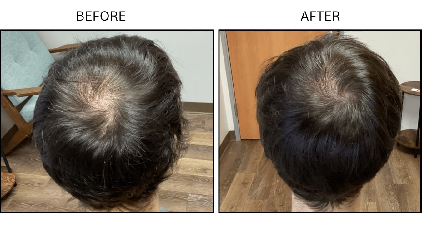 Hair Loss (Medical), before and after photograph 16