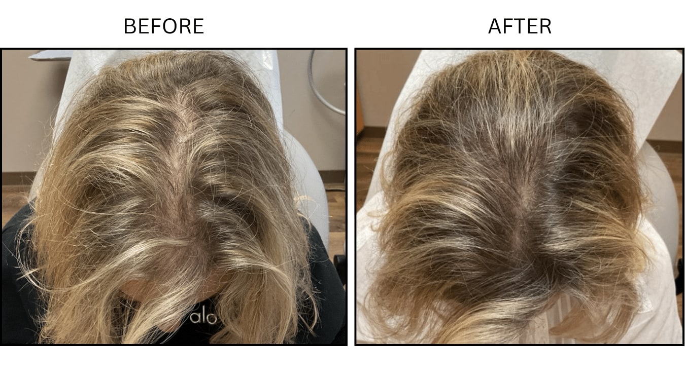 Hair Loss (Medical), before and after photograph 17