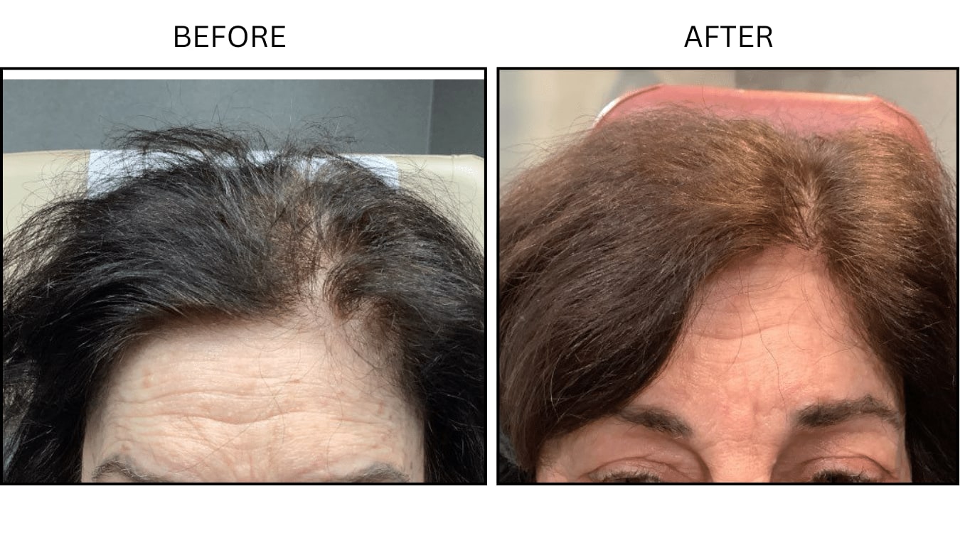 Hair Loss (Medical), before and after photograph 1