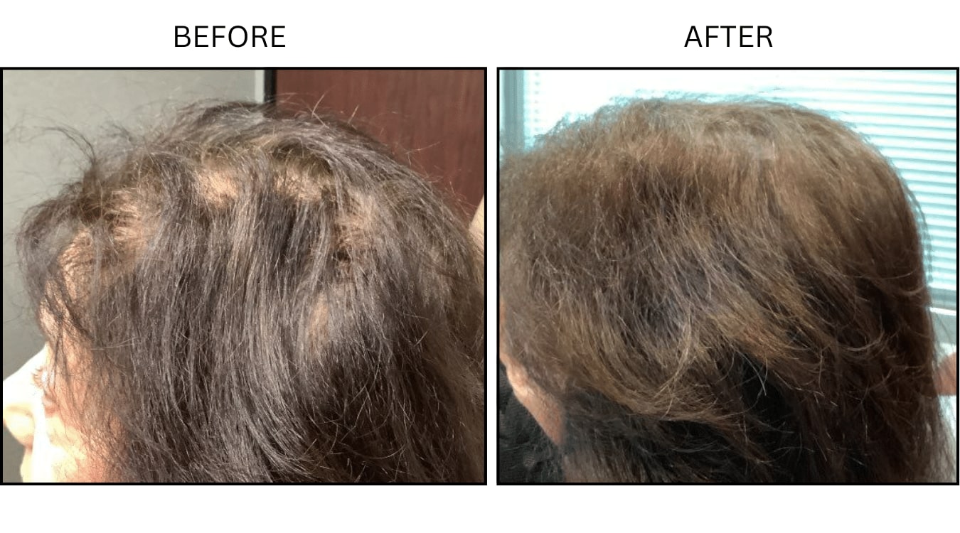 Hair Loss (Medical), before and after photograph 2