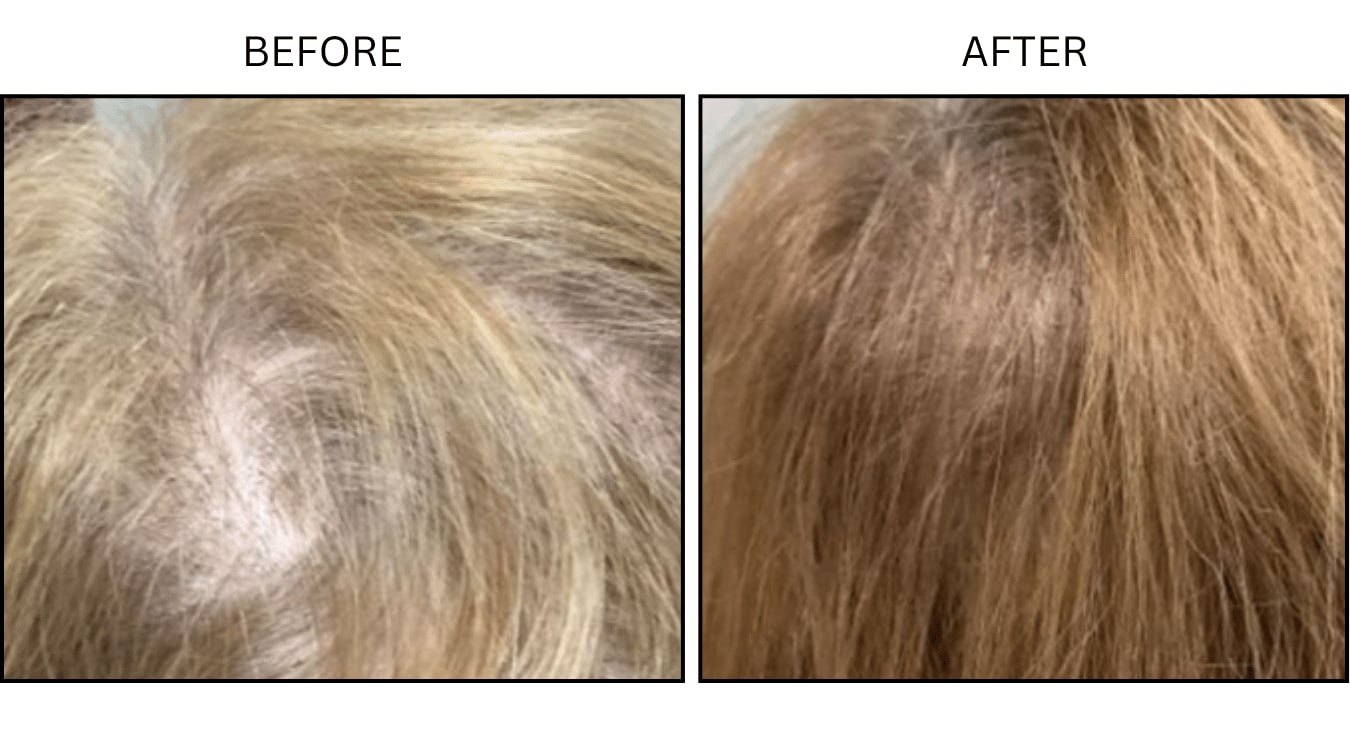 Hair Loss (Medical), before and after photograph 3