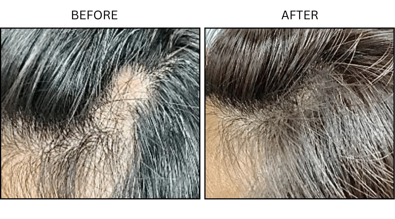 Hair Loss (Medical), before and after photograph 4