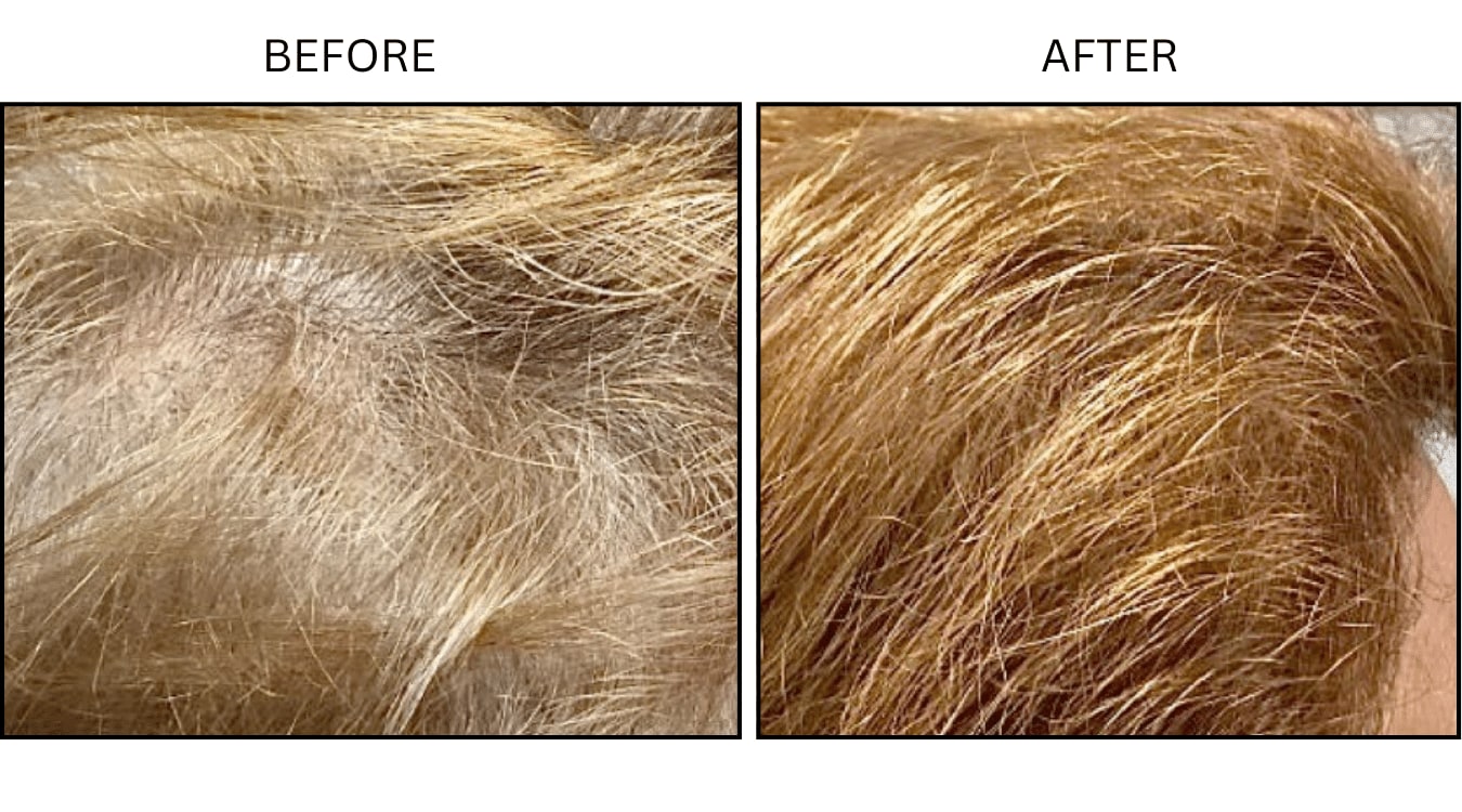 Hair Loss (Medical), before and after photograph 5
