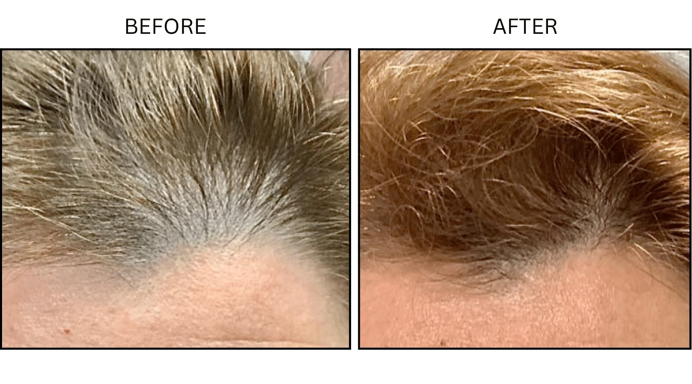 Hair Loss (Medical), before and after photograph 6