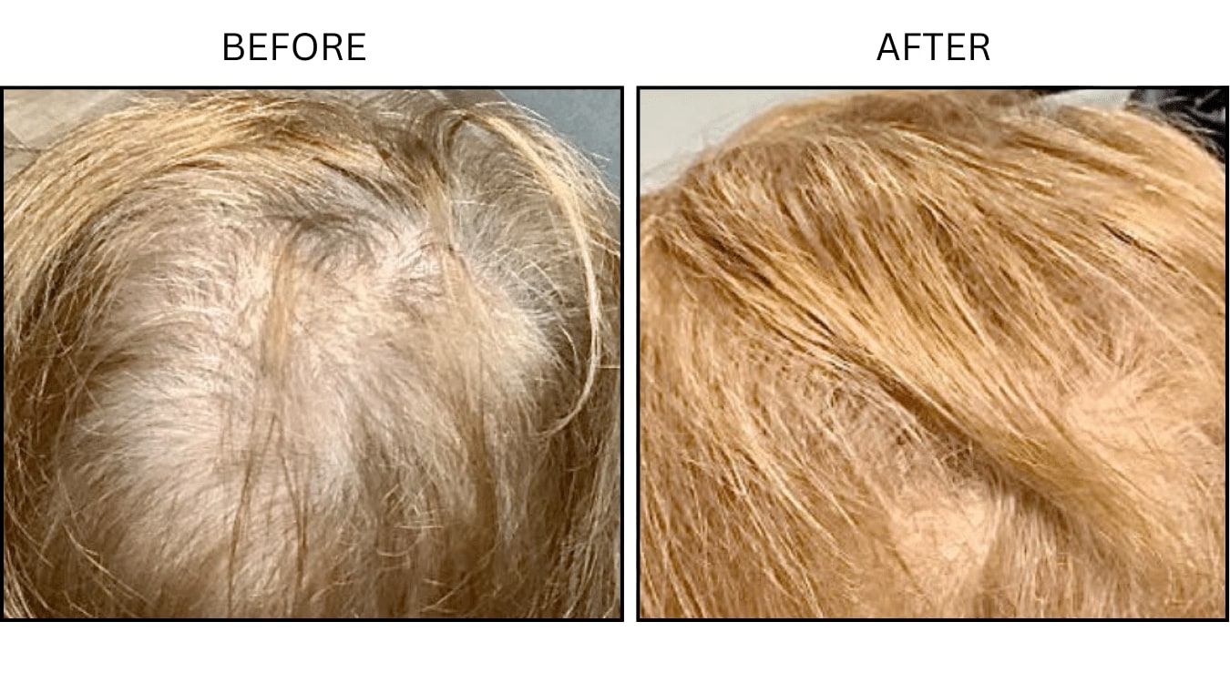 Hair Loss (Medical), before and after photograph 7