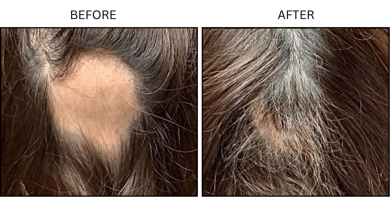 Hair Loss (Medical), before and after photograph 8
