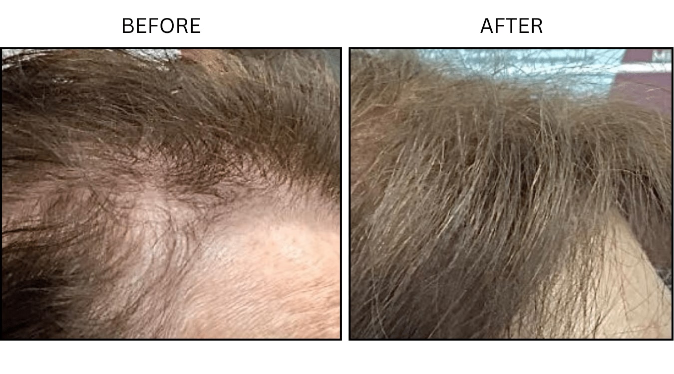 Hair Loss (Medical), before and after photograph 9